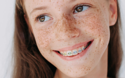 3D-Printed Braces: The Future of Custom Orthodontics in 2025 with LightForce and SureSmile® Advanced