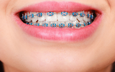Why Regular Orthodontic Checkups Matter for a Healthy Smile