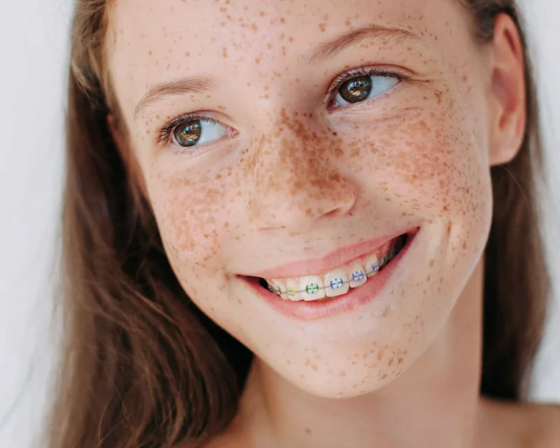 Smiling freckled girl with colorful elastics on her metal braces
